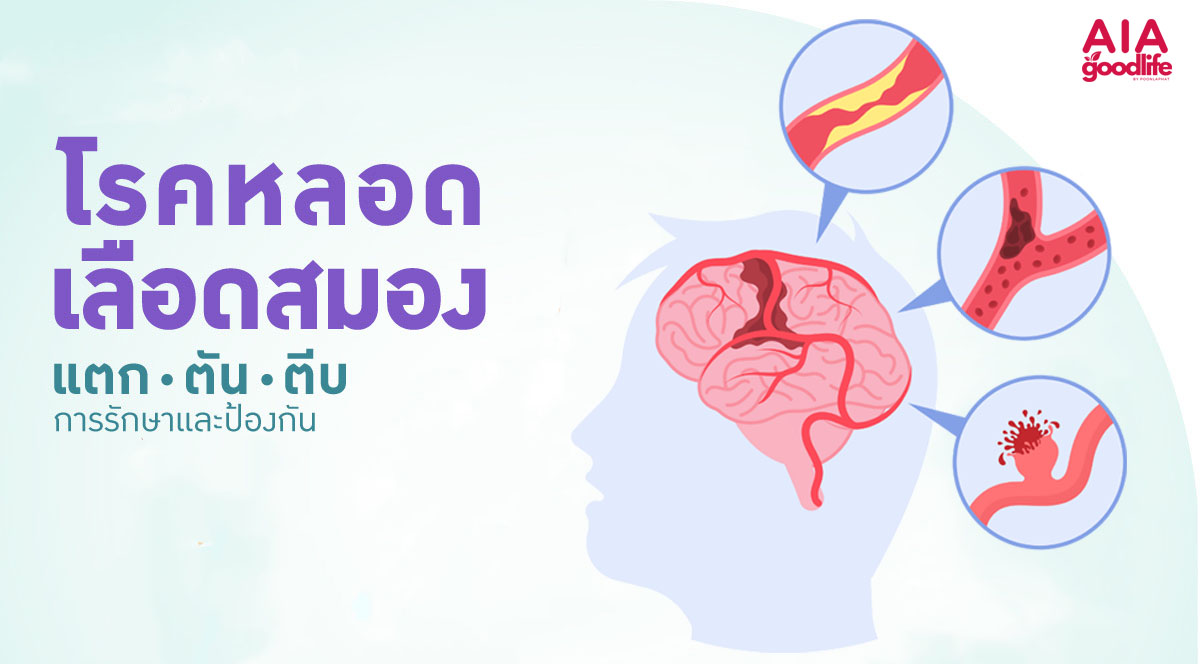 โรคหลอดเลือดในสมอง Stroke