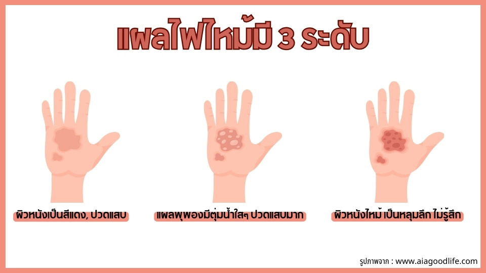 แผลไฟไหม้มีกี่ระดับ